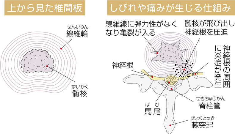 椎間板ヘルニアについて