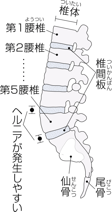 椎間板ヘルニアについて